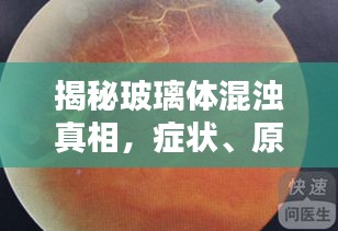 揭秘玻璃体混浊真相，症状、原因及治疗方法一网打尽！